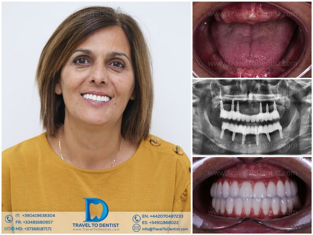 Caso dental - Resultado de tratamiento