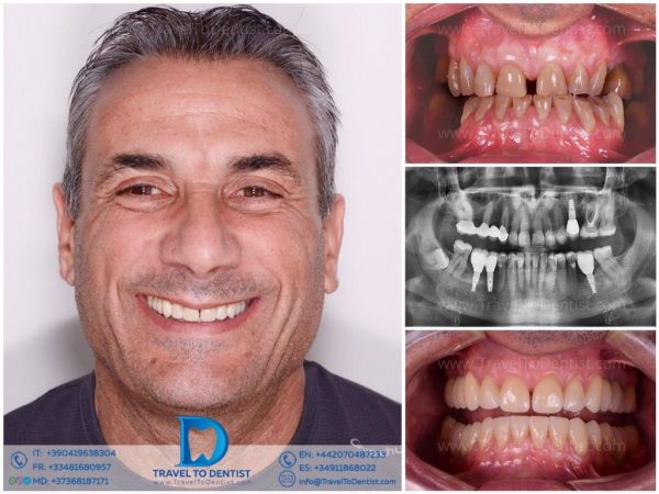 Caso dental - Resultado de tratamiento