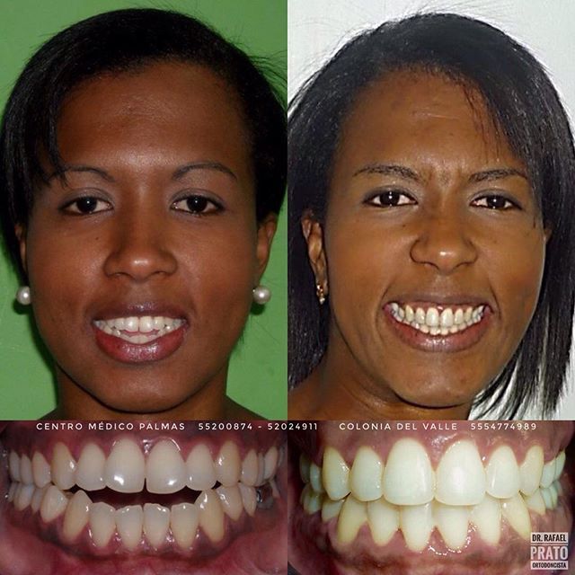 Caso dental - Resultado de tratamiento